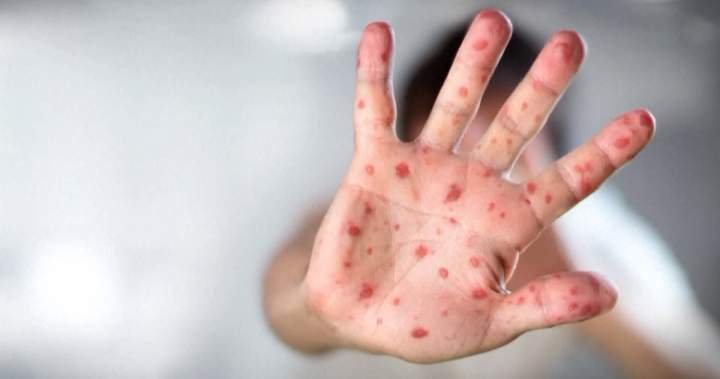Manitoba sees 44 measles circumstances in first week of February – Winnipeg Manitoba sees 44 measles circumstances in first week of February – Winnipeg