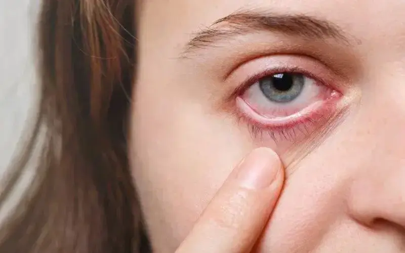 Dry eyes: Signs, causes, remedy, prevention