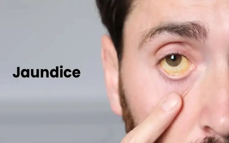 What’s Jaundice? Signs, causes, therapy, prevention